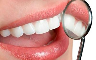 Limpieza dental, ¿qué es y cuándo realizarla?